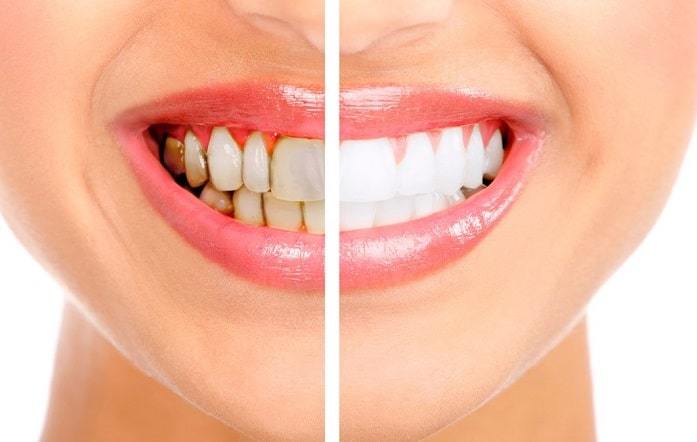cost of teeth whitening 
